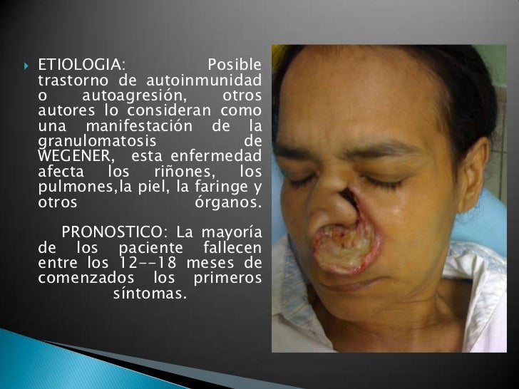granuloma letal de la linea media